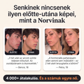 Norvi Pattanás-Stop – 4 000+ átalakulás, előtte-utána